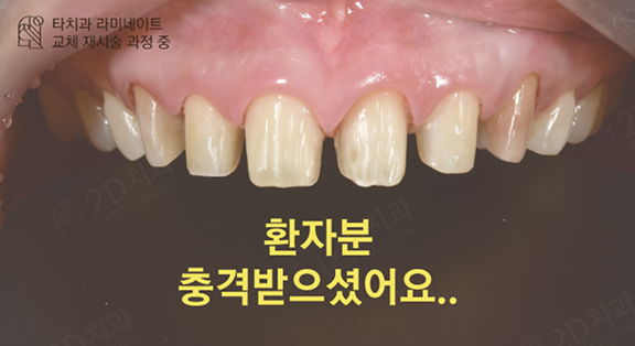 무삭제 라미네이트 90%가 후회한다는데 진짜 이유는? 본문 이미지 01