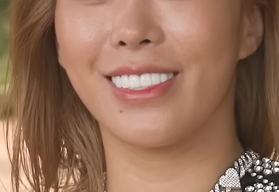 무삭제 라미네이트 90%가 후회한다는데 진짜 이유는? 본문 이미지 02